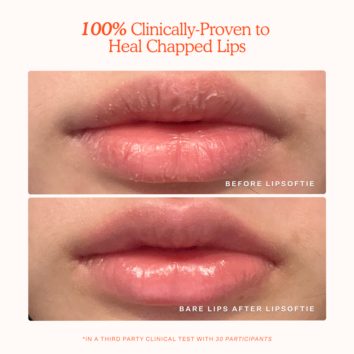 LipSoftie® Lip Treatment H3