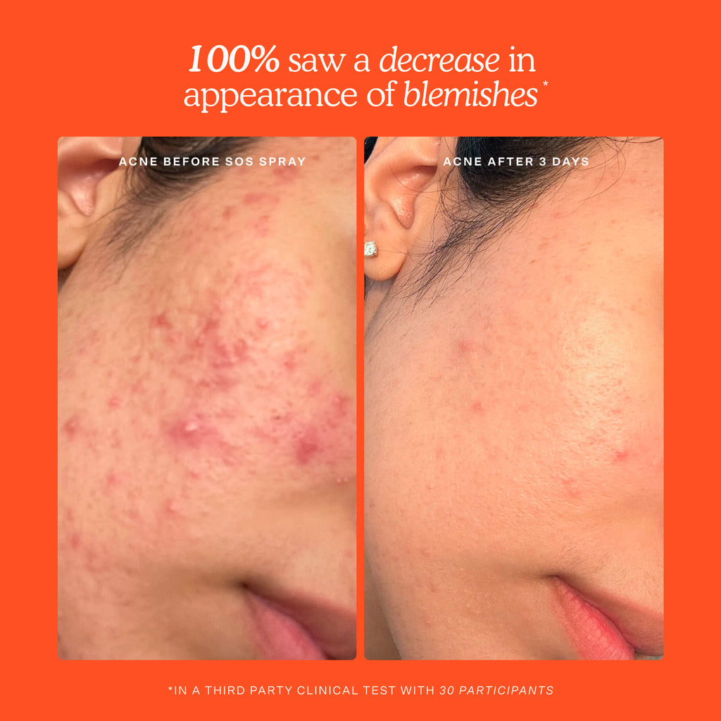 SOS Skincare Minis Kit Y1