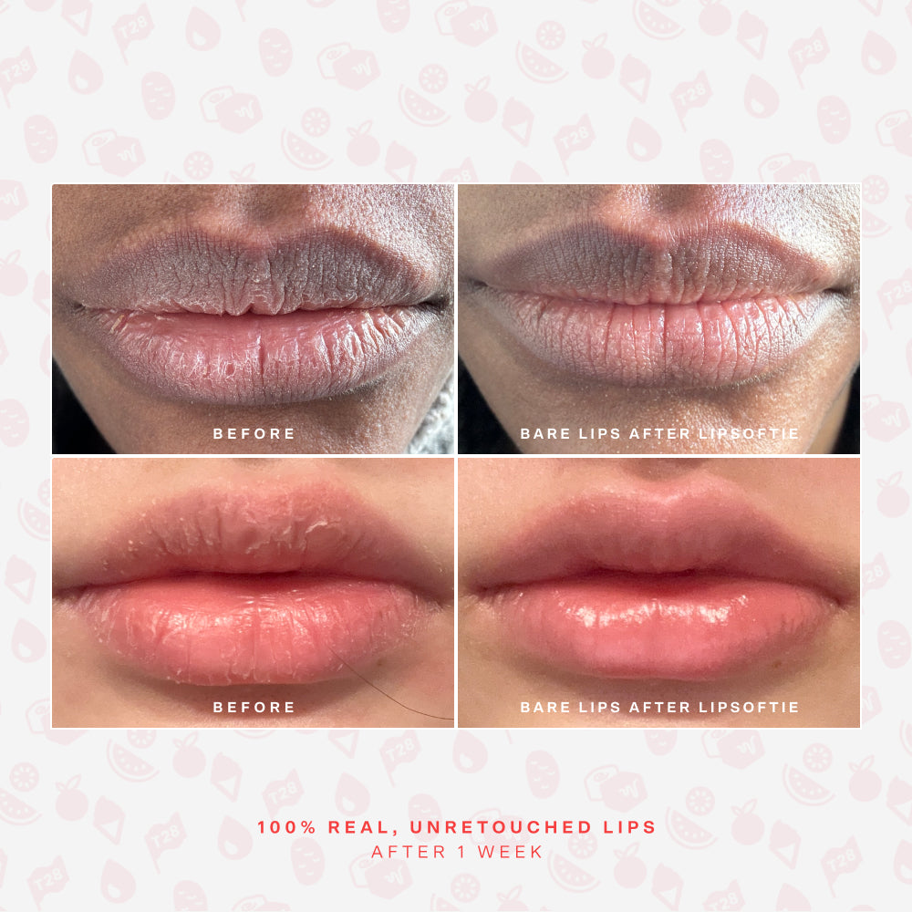 LipSoftie® Lip Treatment Set A3
