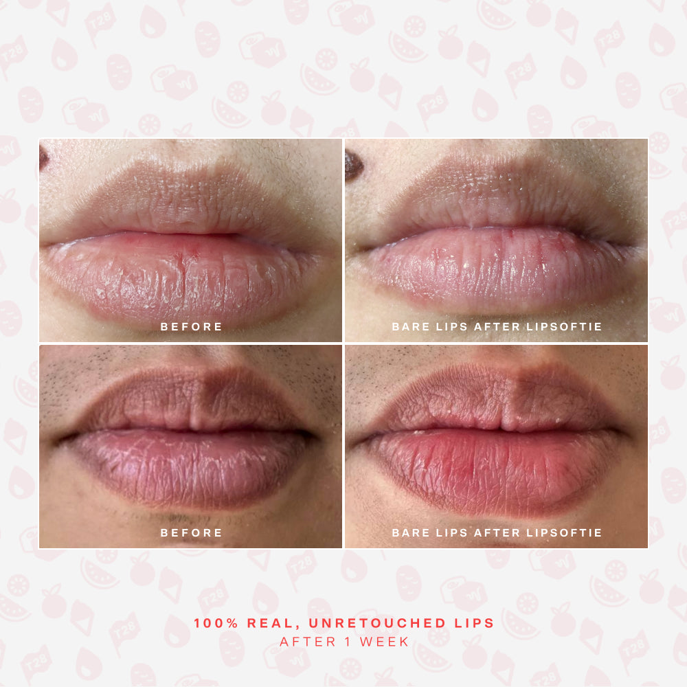 LipSoftie® Lip Treatment Set A3
